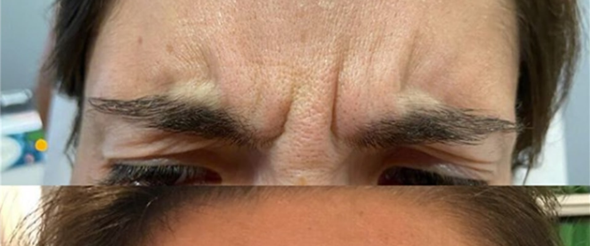 What toxin is used in plastic surgery?