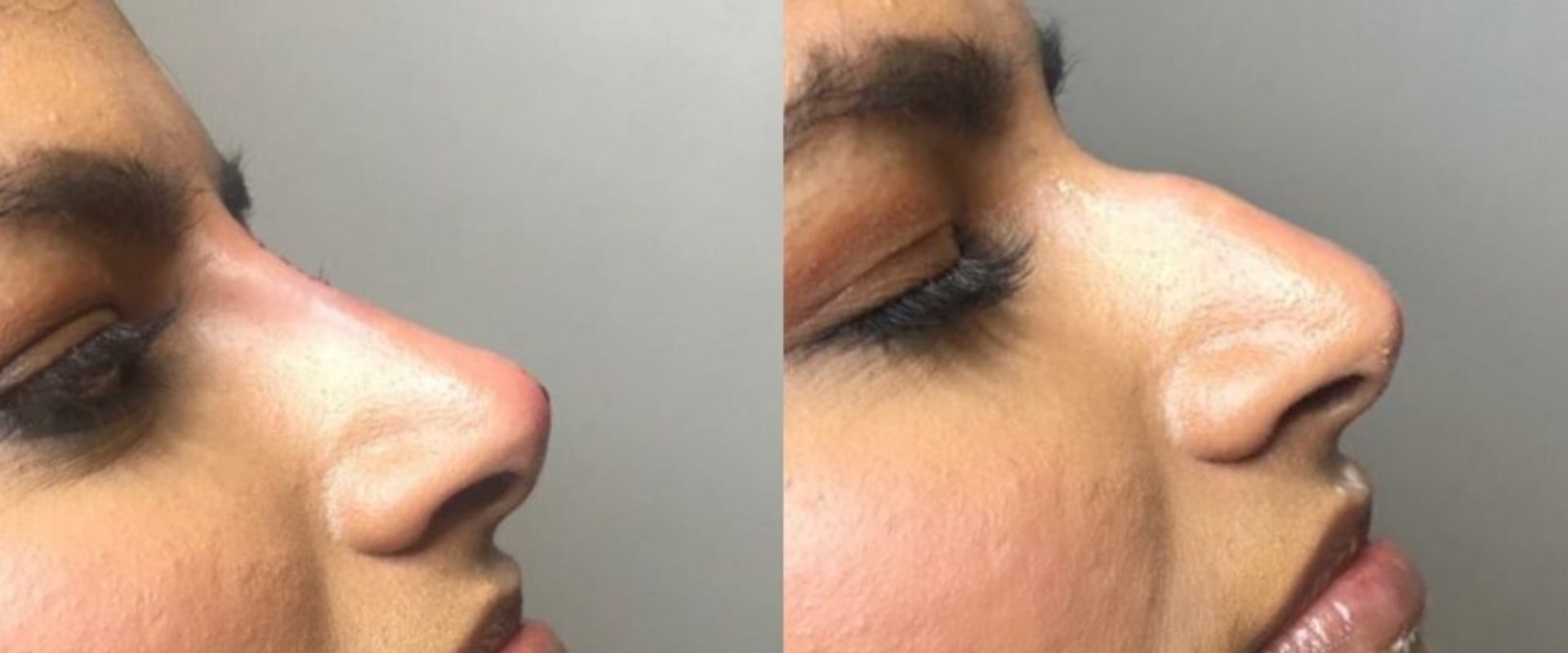 What is the least painful cosmetic surgery?