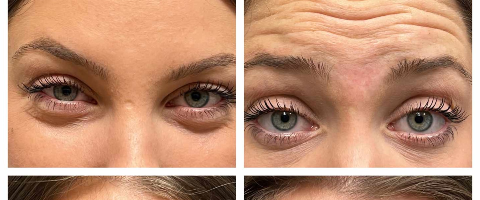 Is botox a cosmetic procedure?