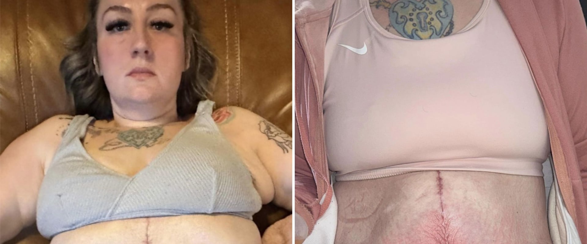 How common are botched tummy tucks?