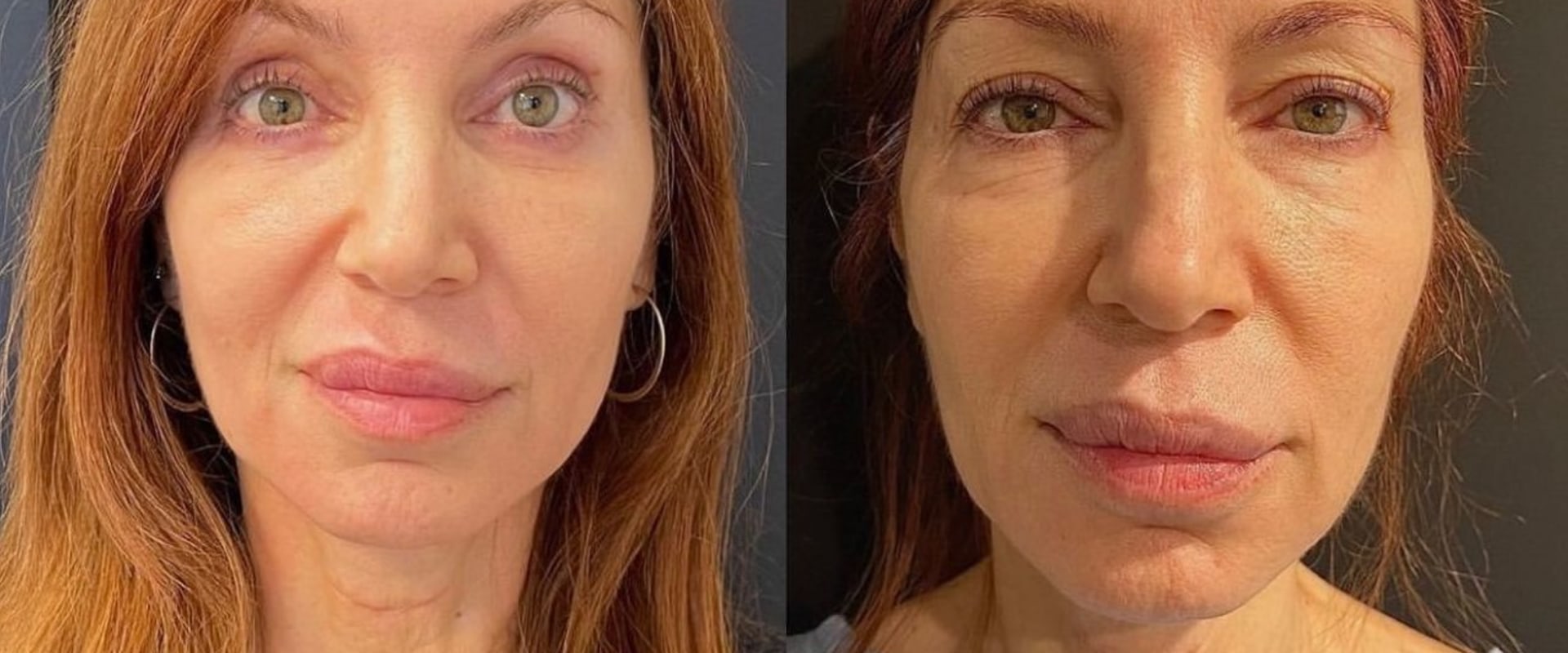What is the word for surgery for looks?