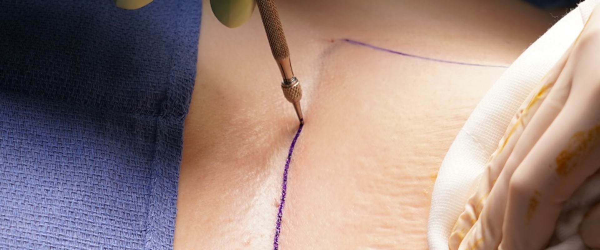 What chemicals are used in plastic surgery?