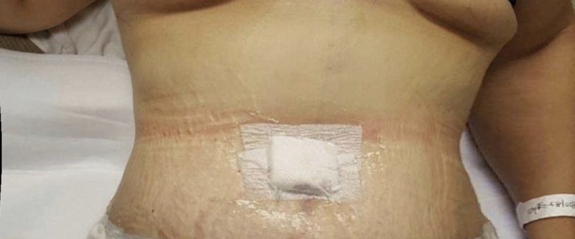 Can tummy tuck muscle repair come undone?