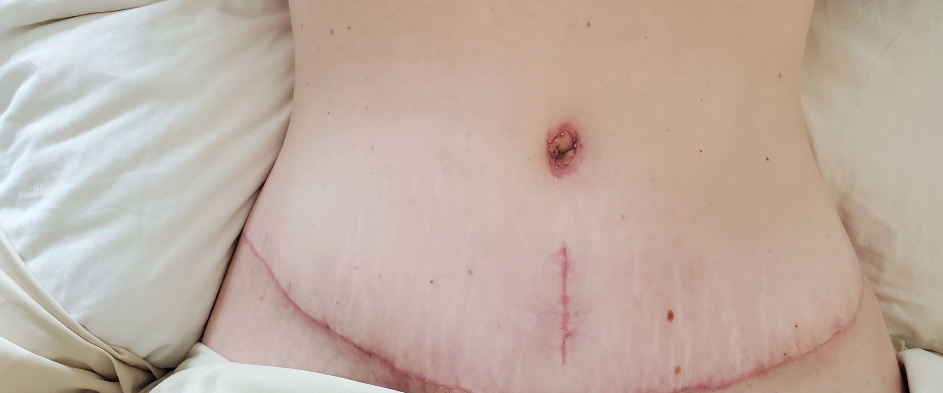 Are tummy tuck complications common?