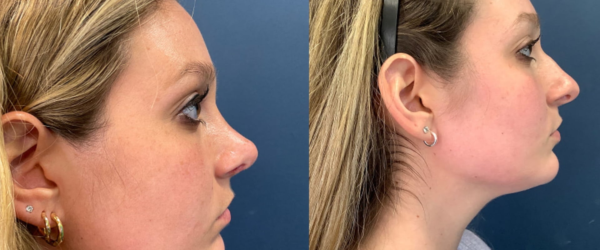 Do you feel different after plastic surgery?