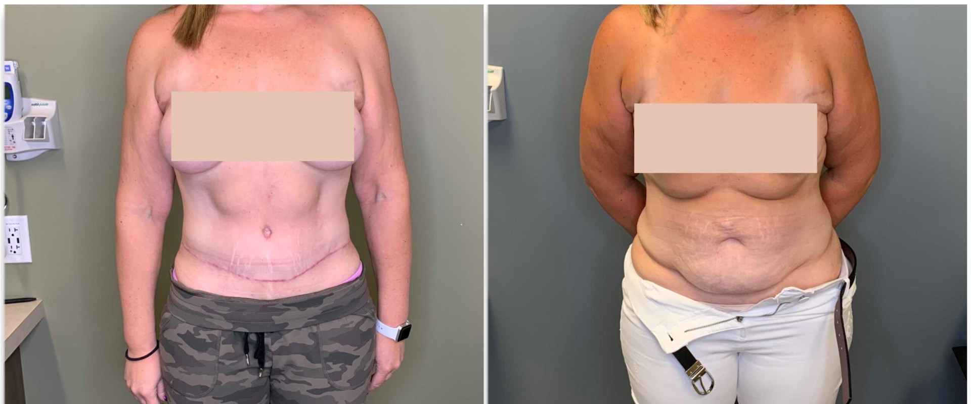 How painful is a tummy tuck recovery?