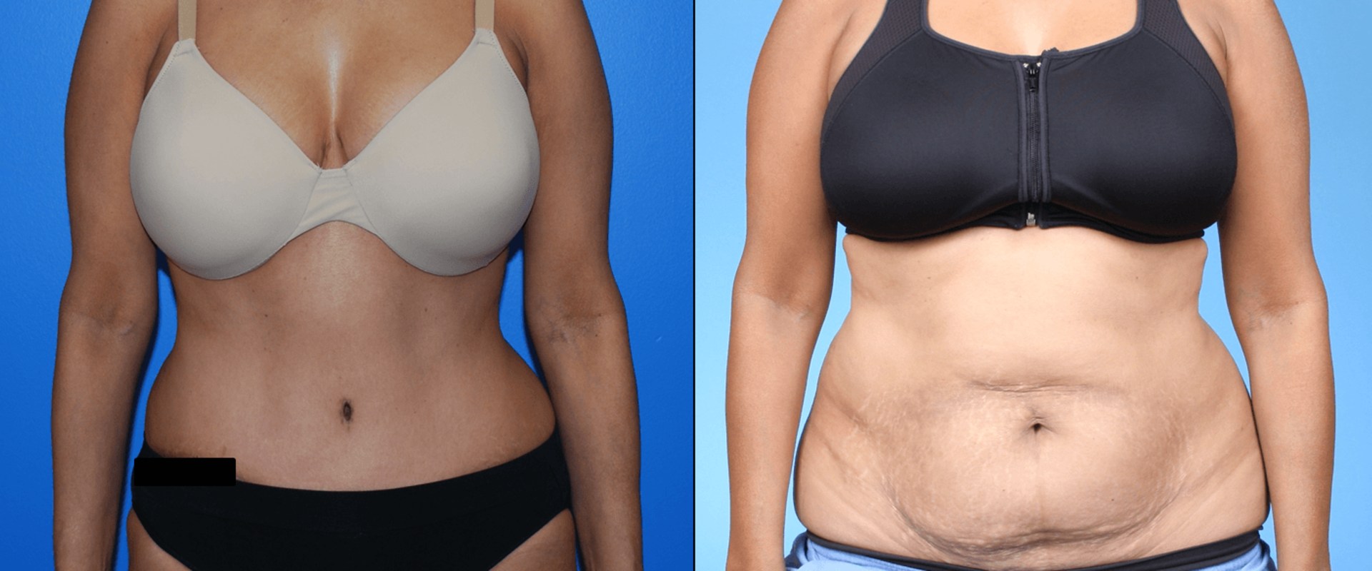 How can i slim down after a tummy tuck?