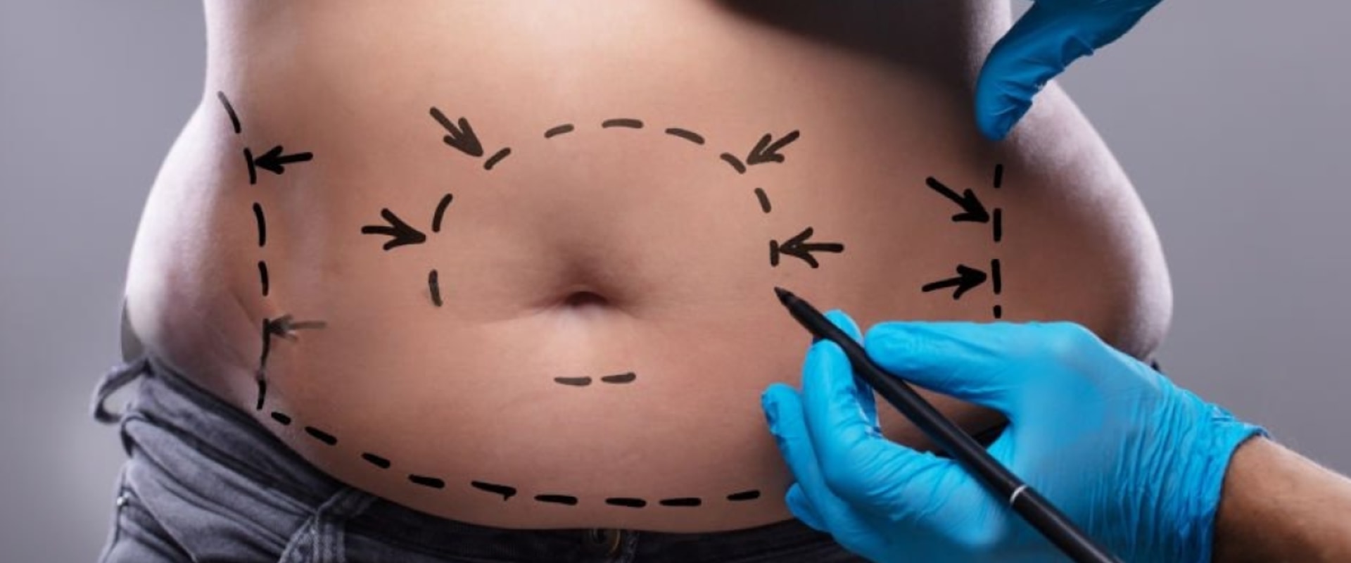 What is the life expectancy of a tummy tuck?