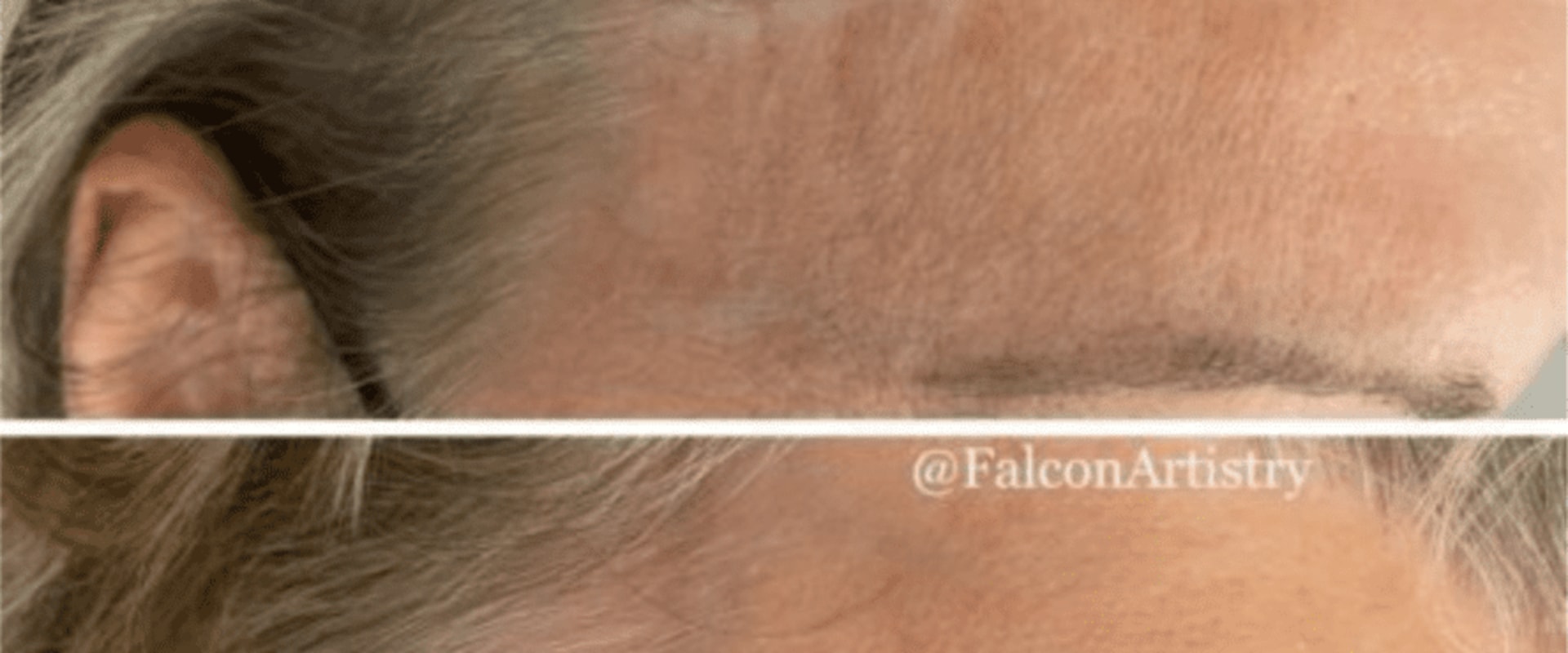 How long does it take to fully heal from top surgery?