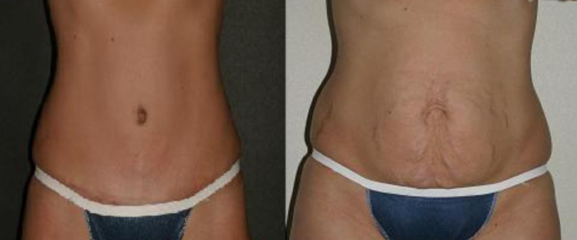 Is a tummy tuck considered a major surgery?