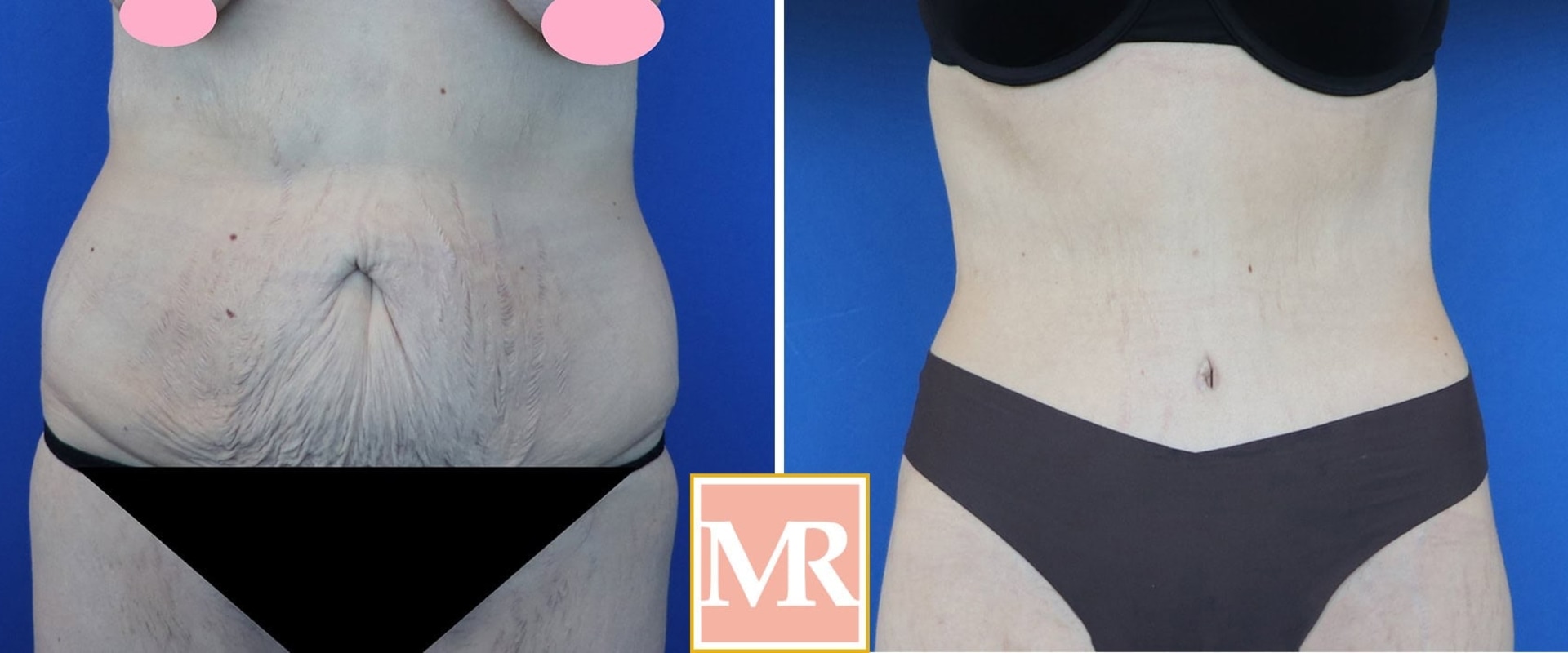 Can you tone your stomach after a tummy tuck?
