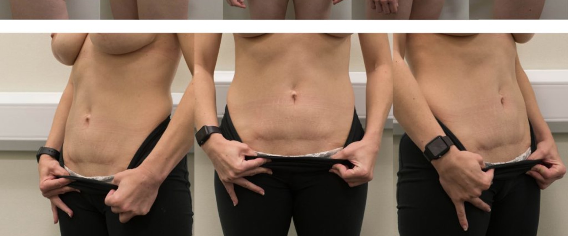 What day do you start feeling better after tummy tuck?