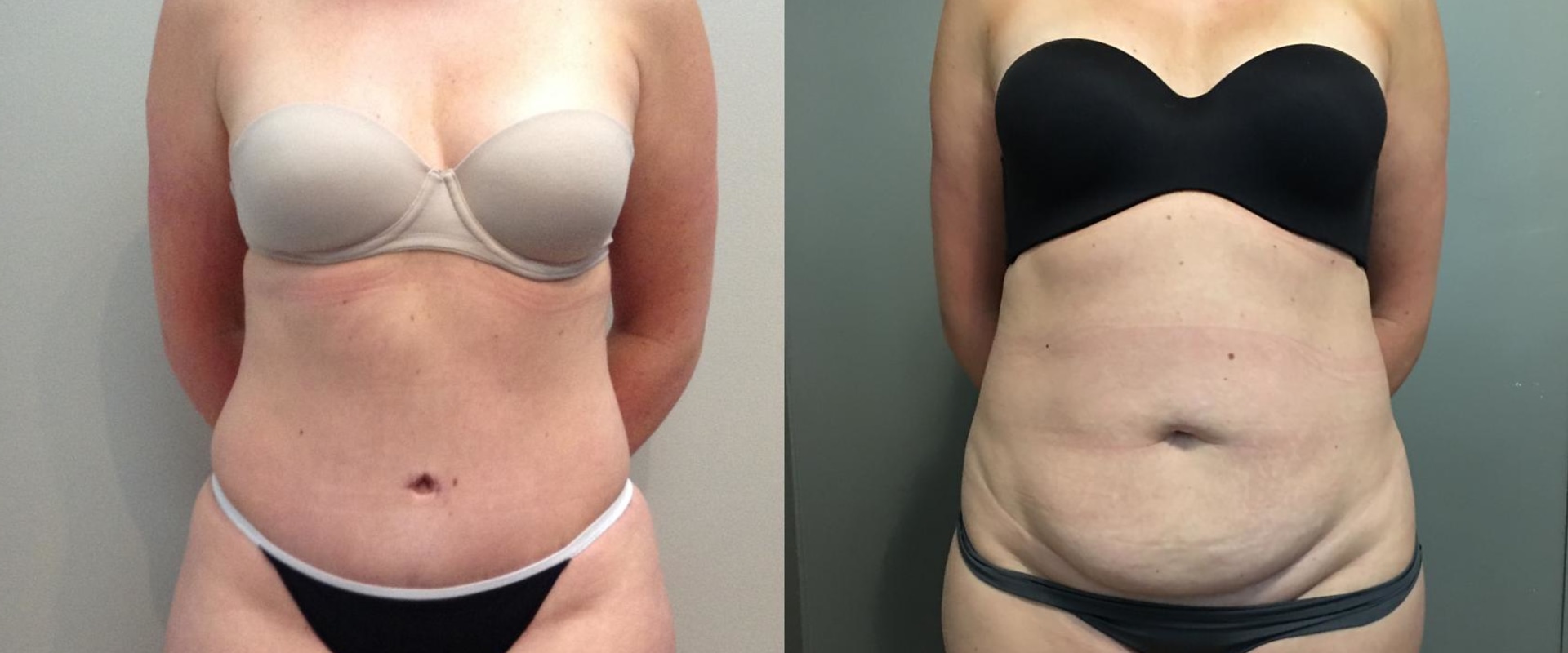What is the satisfaction rate for a tummy tuck?