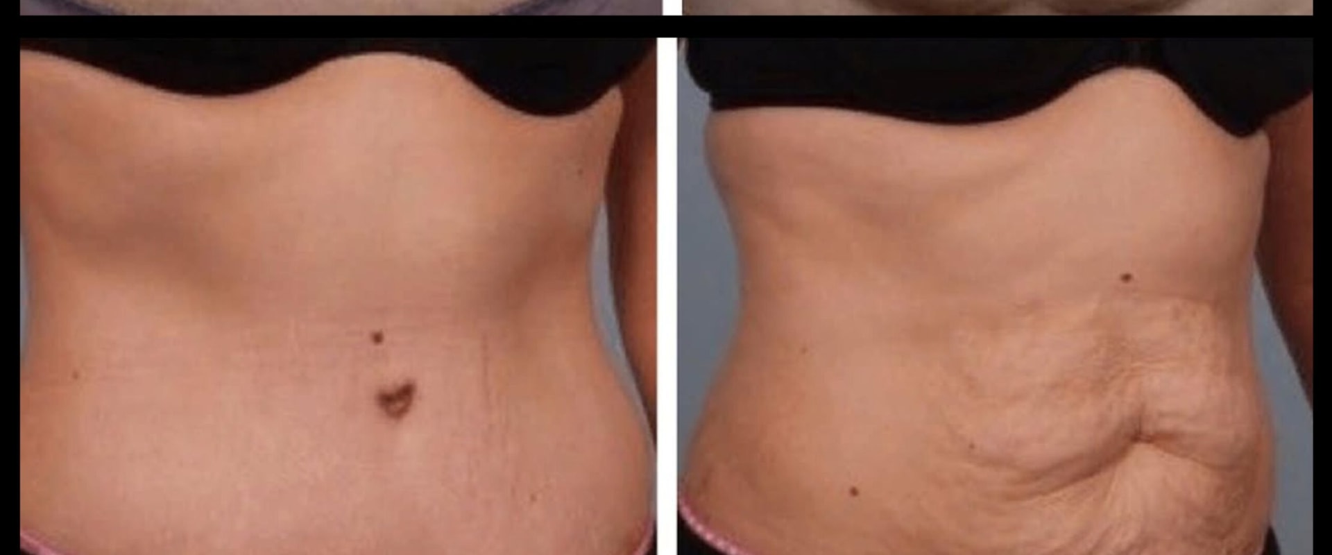 How long until tummy is flat after tummy tuck?