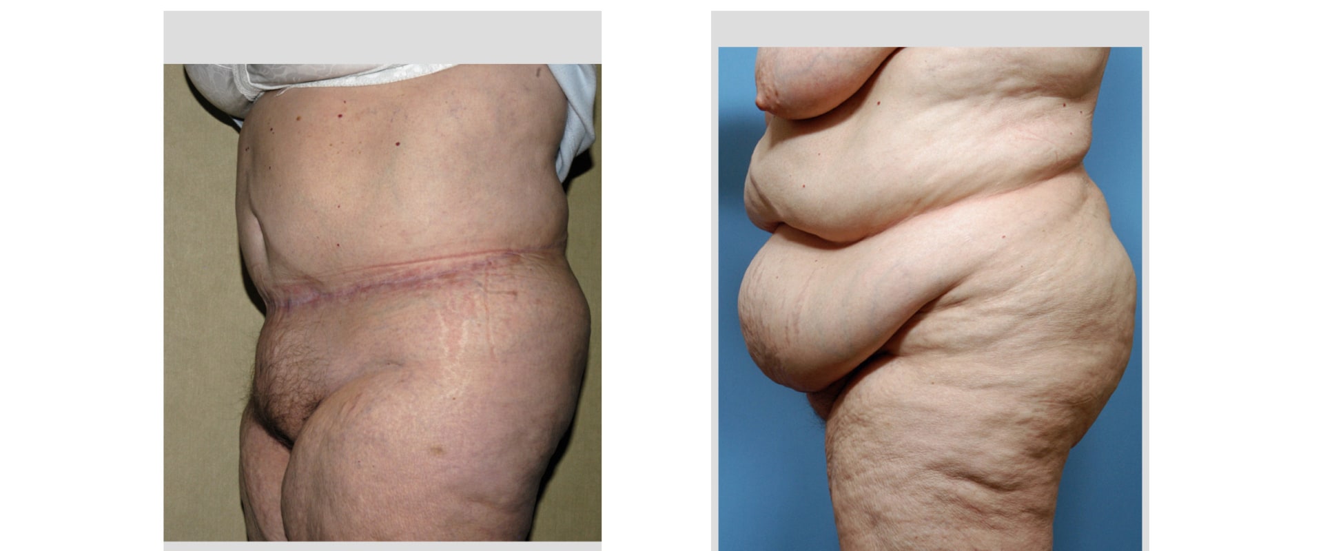 How do you get rid of upper belly bulge after tummy tuck?
