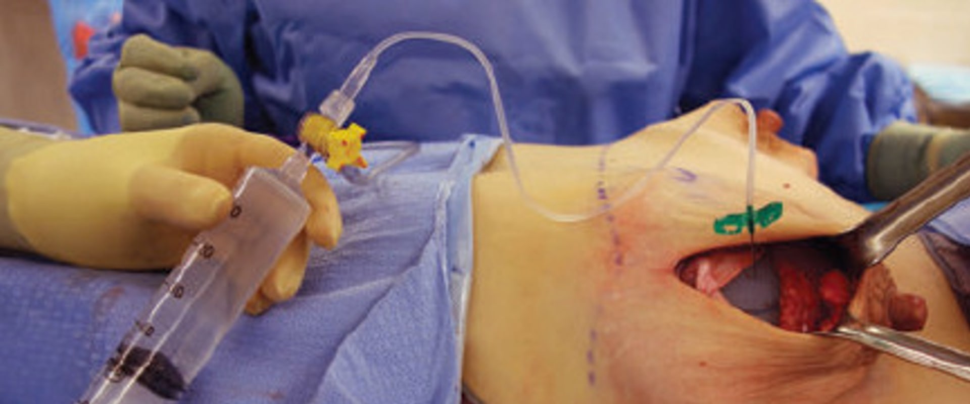What is meant by a plastics procedure?