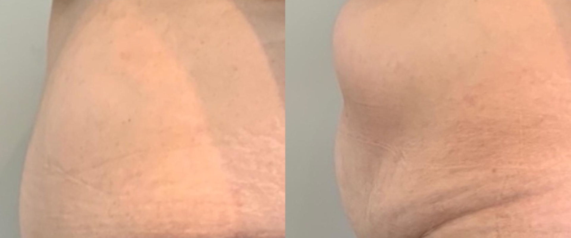 Do you ever get feeling back after a tummy tuck?