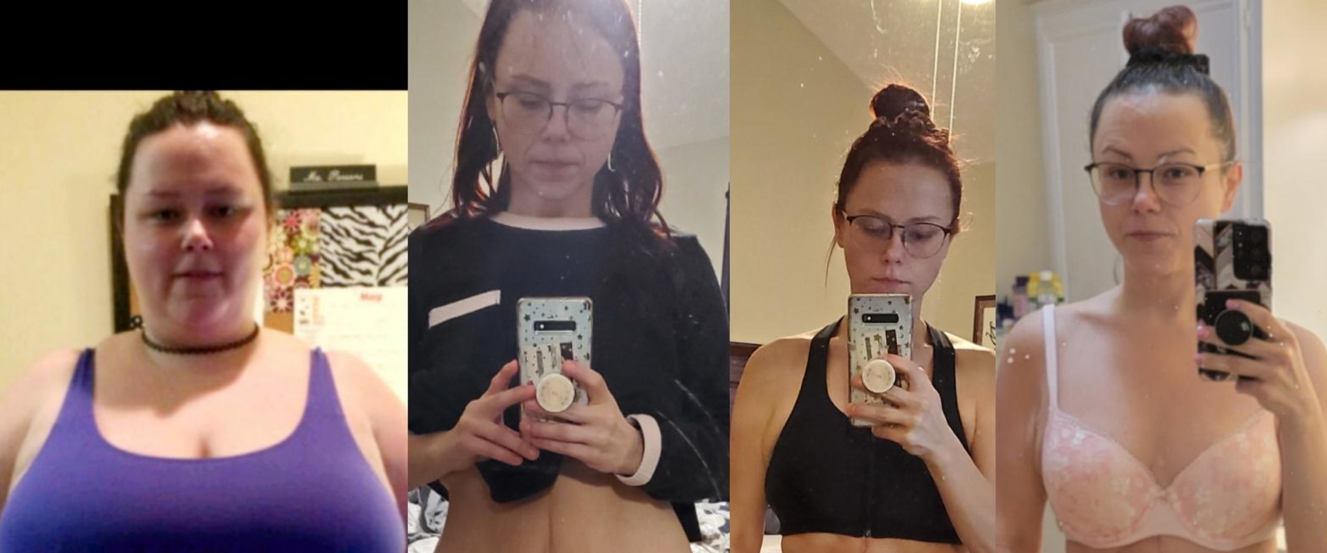 What happens years after a tummy tuck?