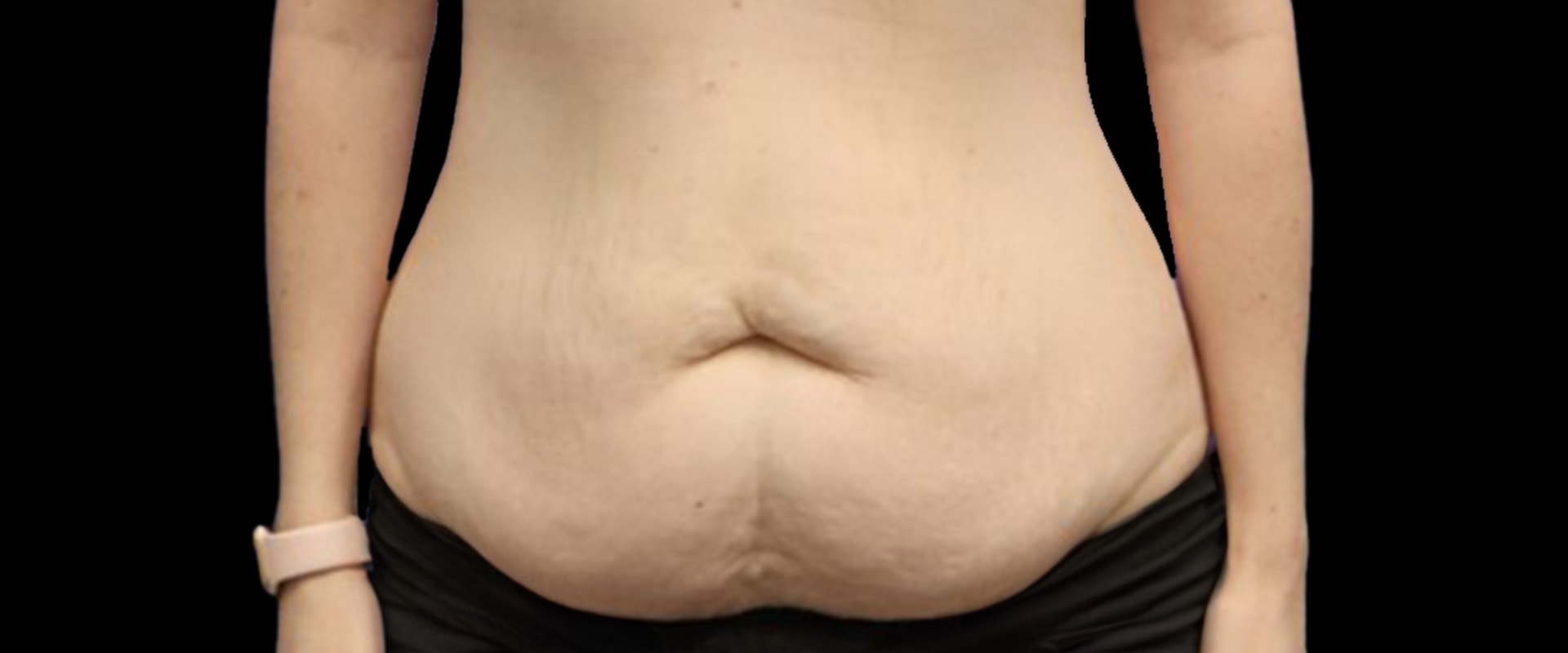 What percentage of tummy tucks are successful?