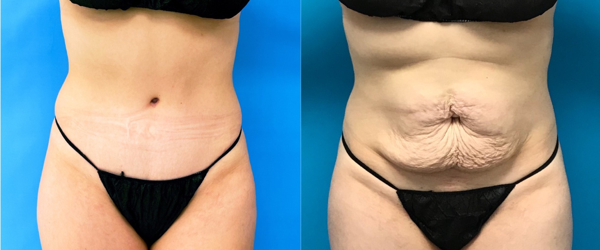 Why i chose not to get a tummy tuck?