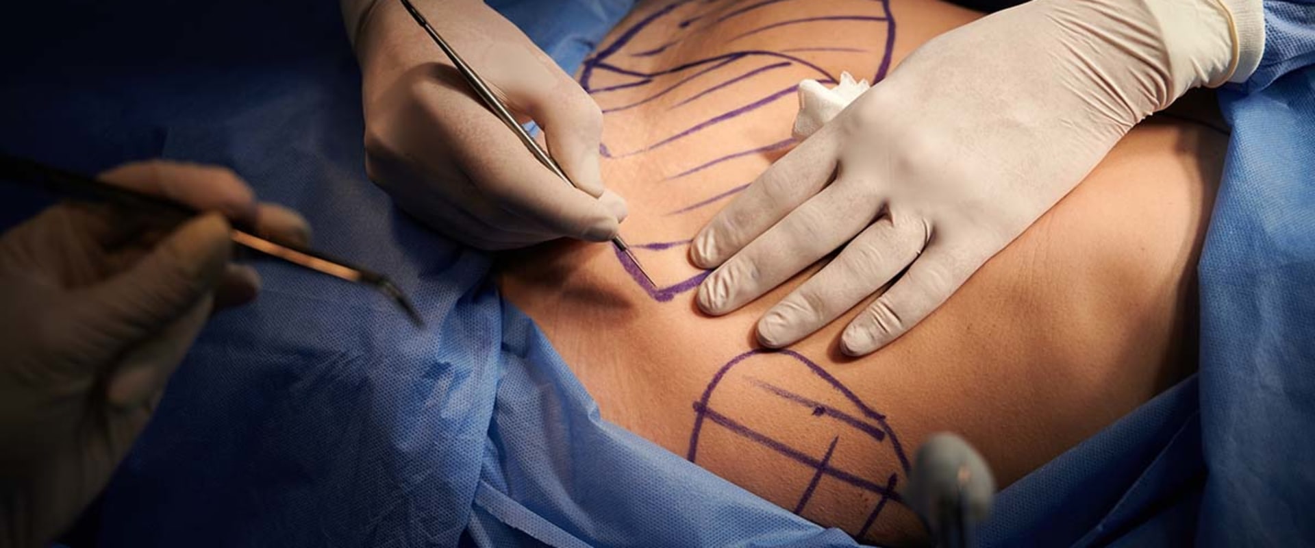 What is the survival rate of plastic surgery?
