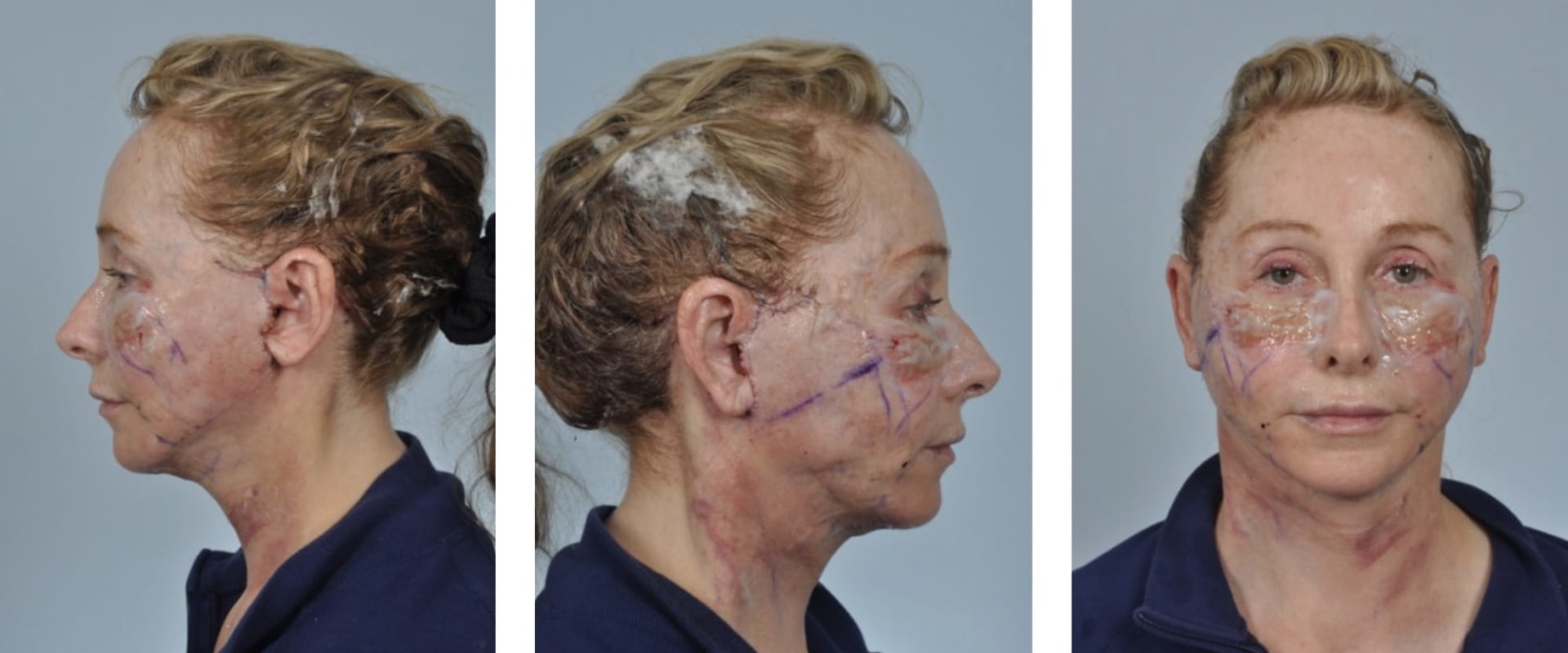 Are most people happy after a facelift?