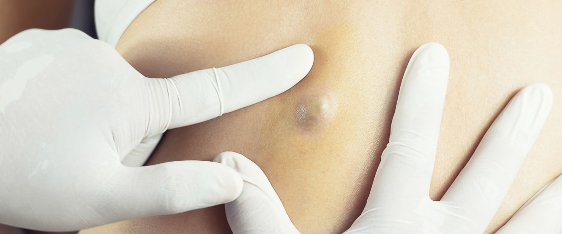 Should a plastic surgeon or dermatologist remove a cyst?