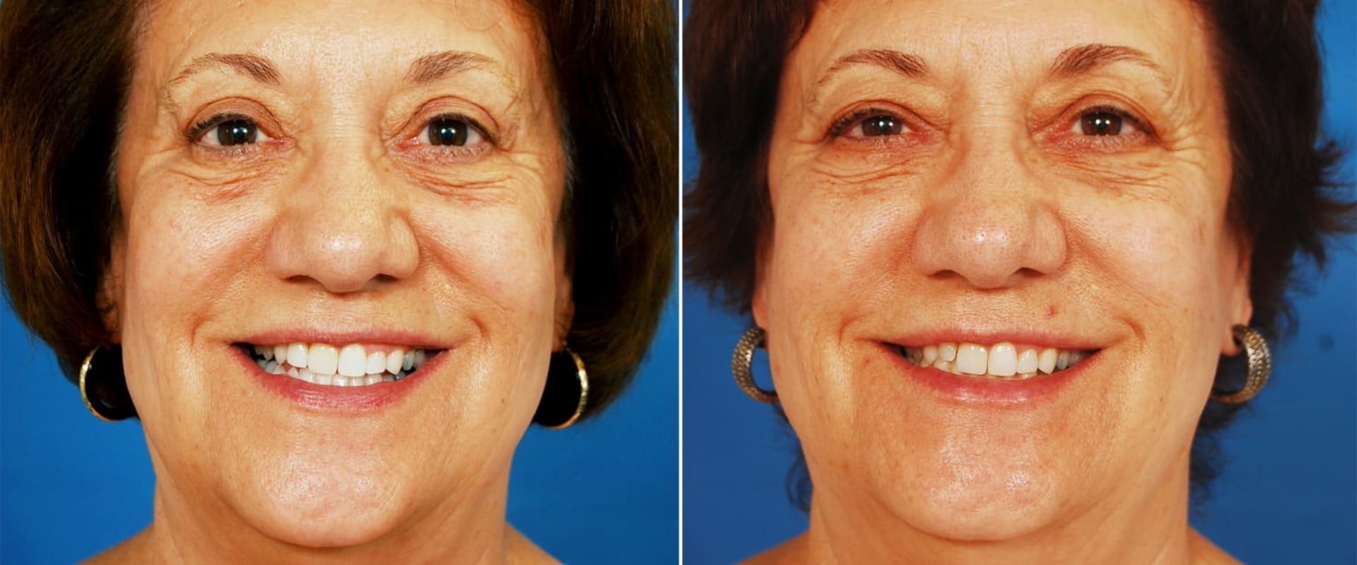 What percentage of people are happy after cosmetic surgery?