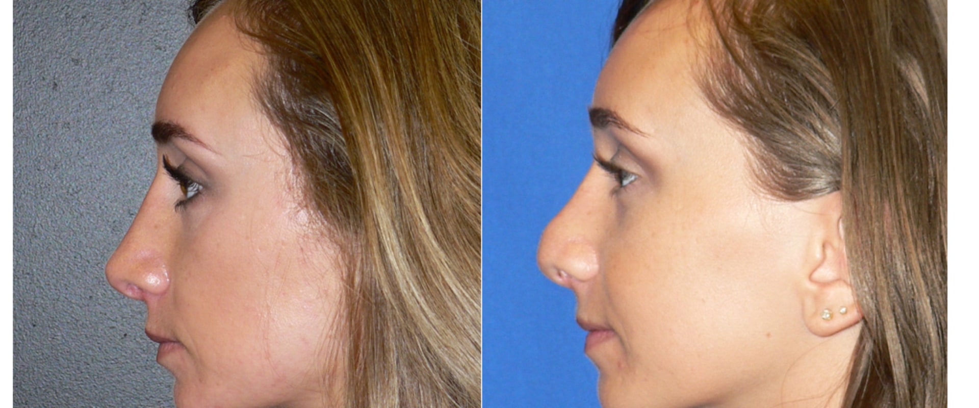 What is the hardest plastic surgery to recover from?