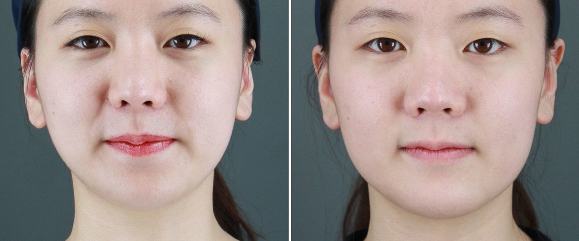 Are people happy after plastic surgery?