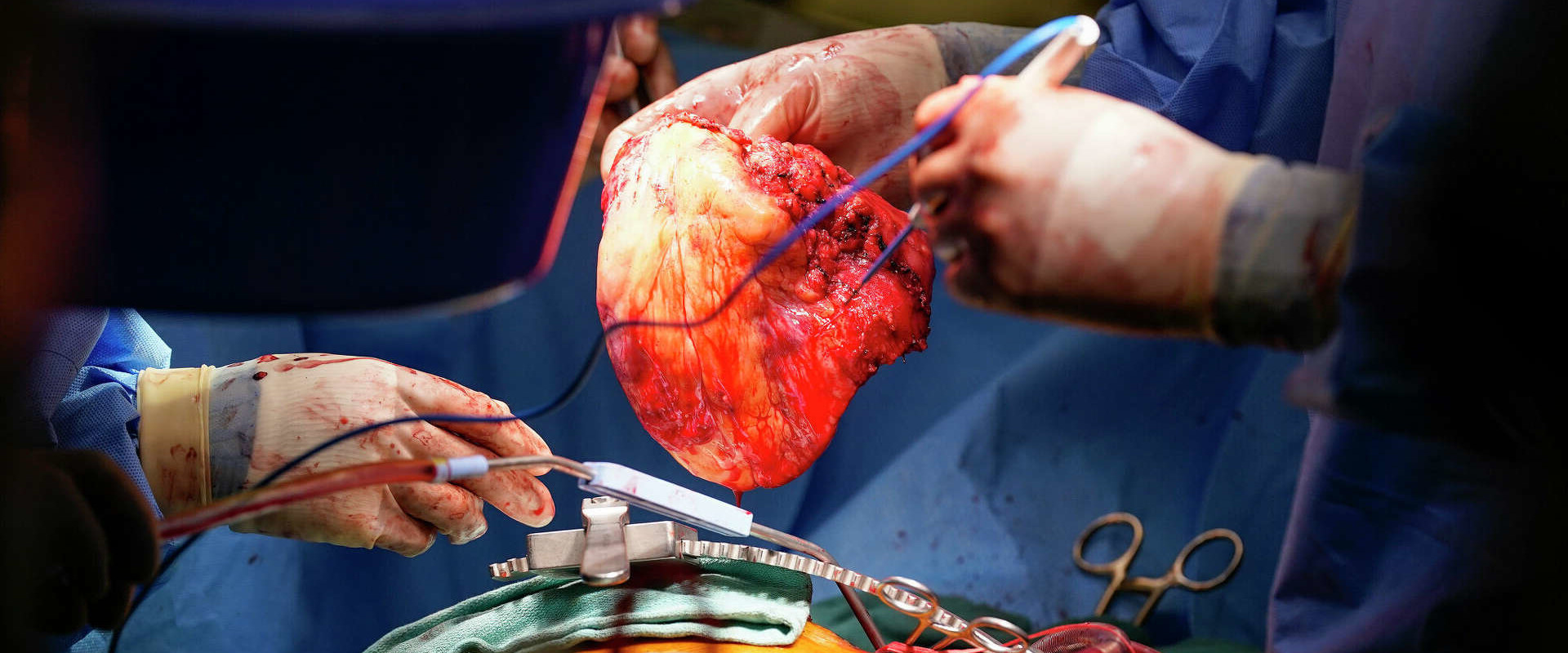What percentage of heart transplant surgeries are successful?