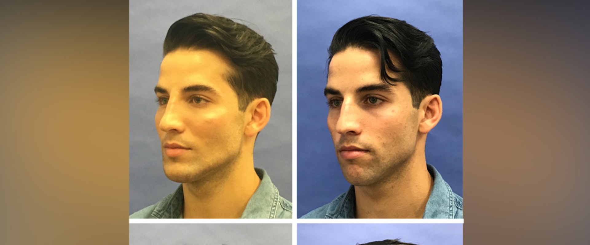 What is the most difficult facial plastic surgery?