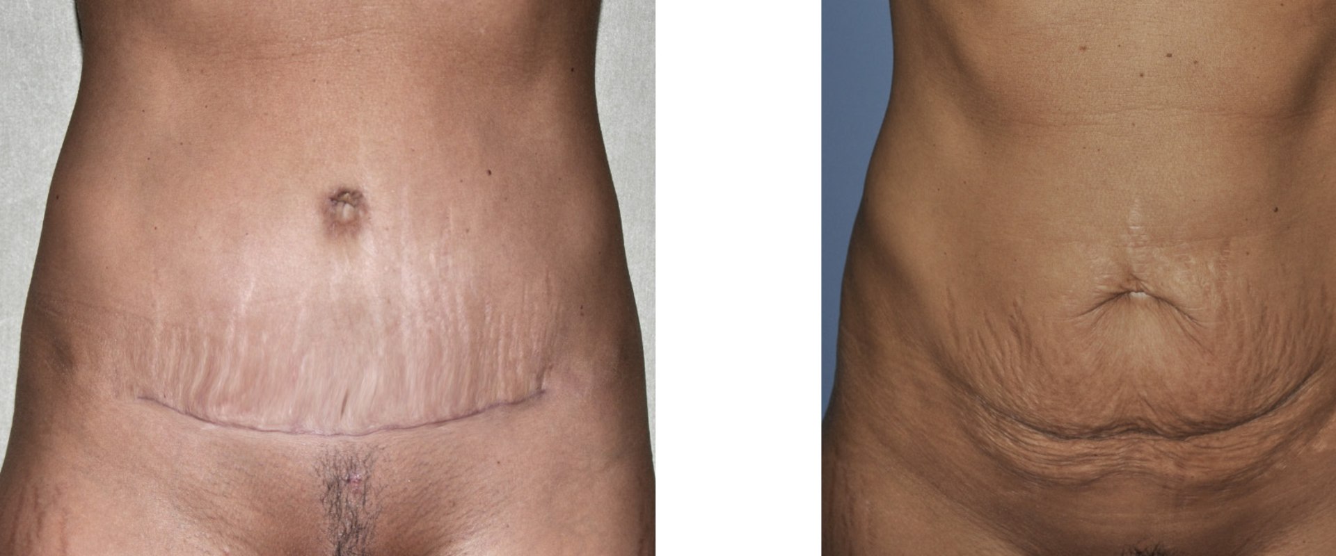 Can you tear your tummy tuck?