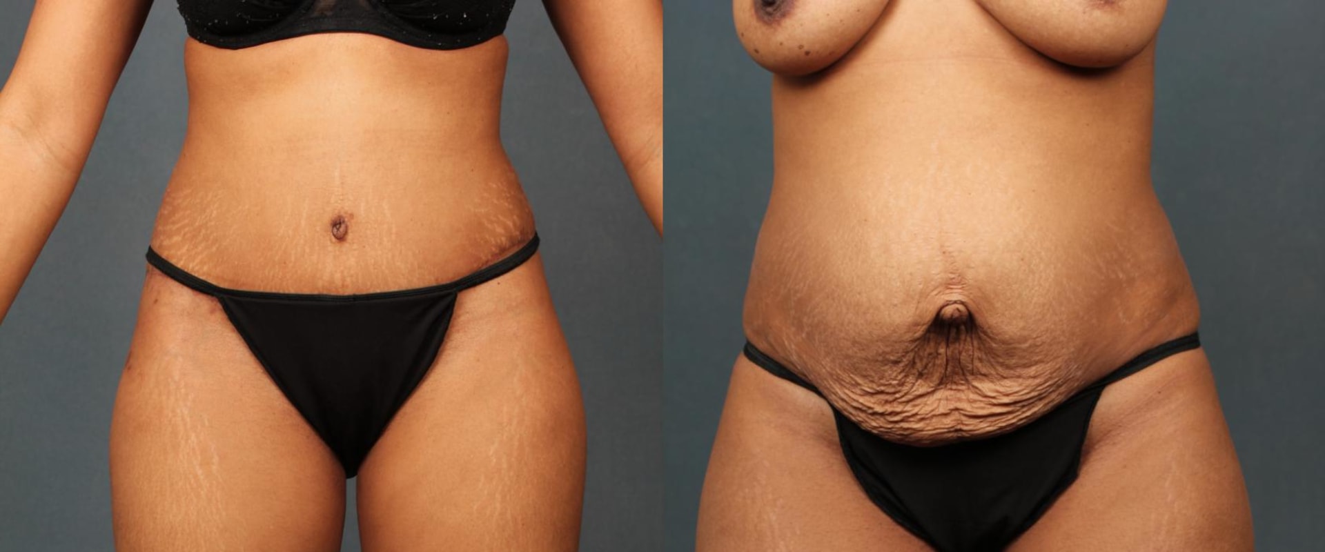 Is tummy tuck worth the risk?