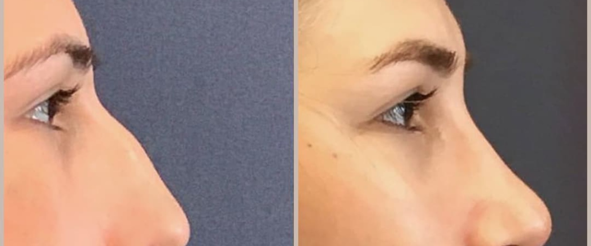 What is the highest risk cosmetic surgery?