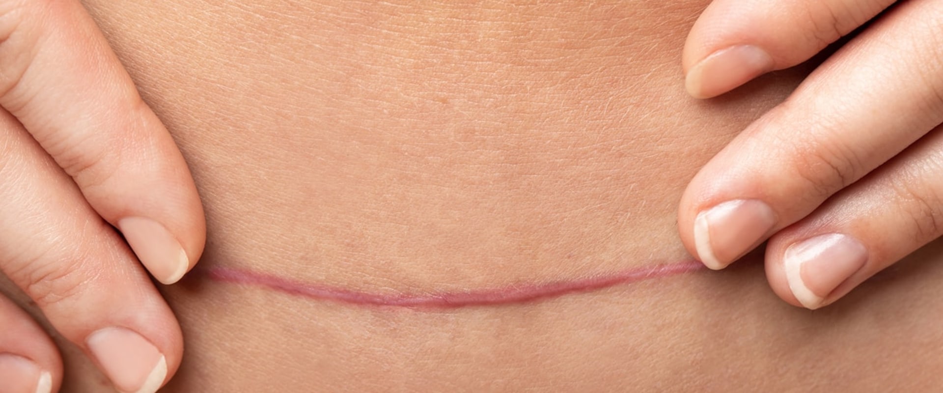 What is the failure rate of tummy tuck?