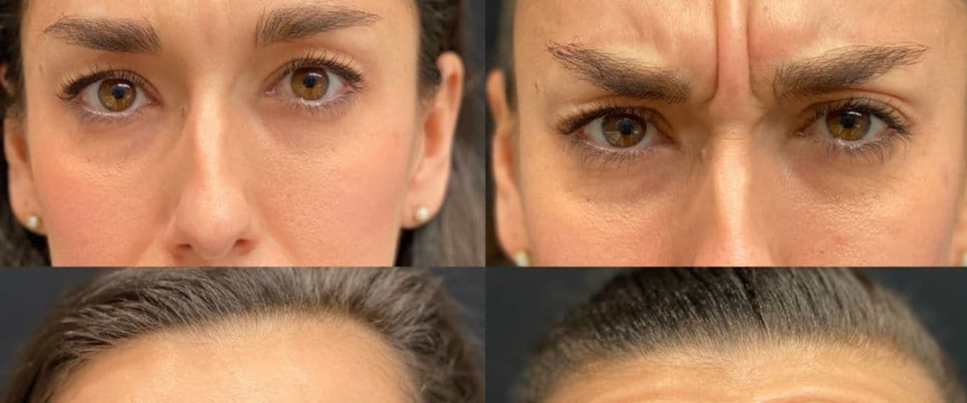 What category does botox fall under?