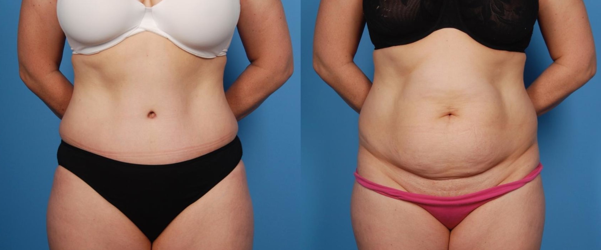 What happens to a tummy tuck as you age?