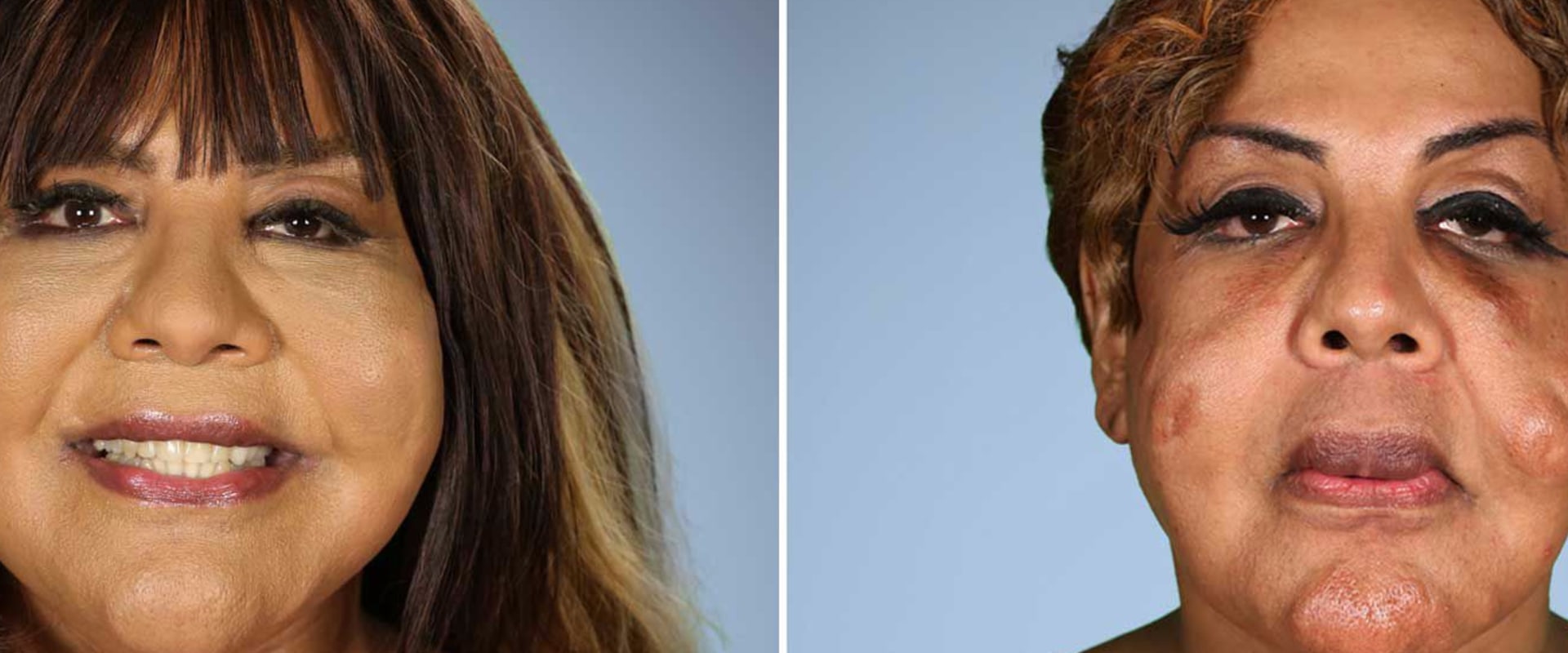 What plastic surgery has the lowest satisfaction rate?