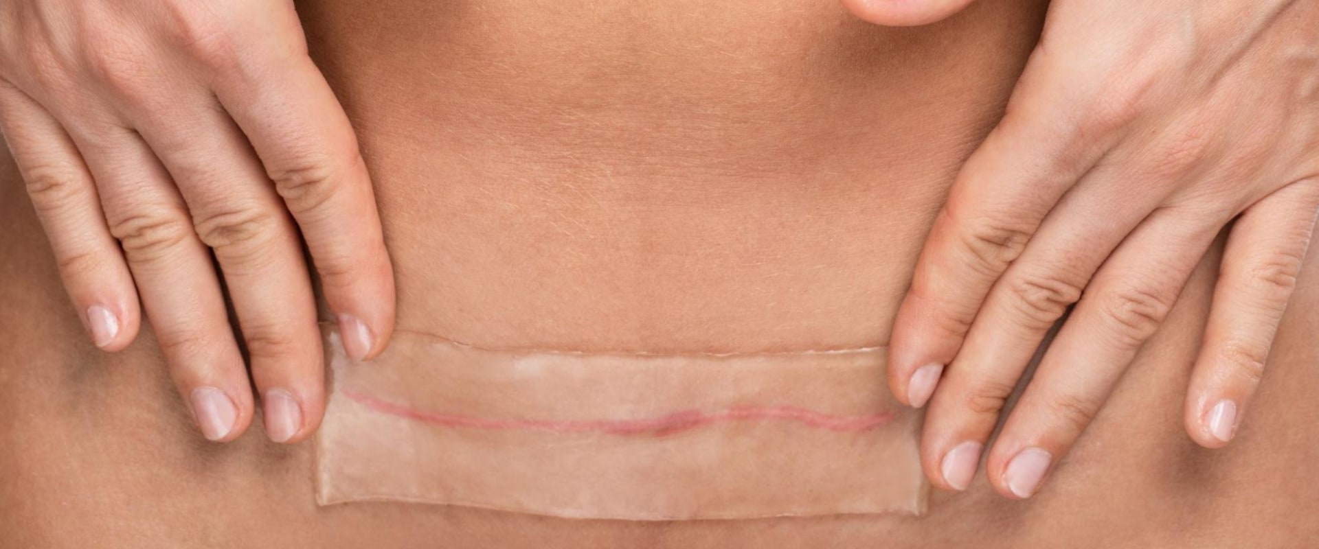 When does a tummy tuck stop hurting?
