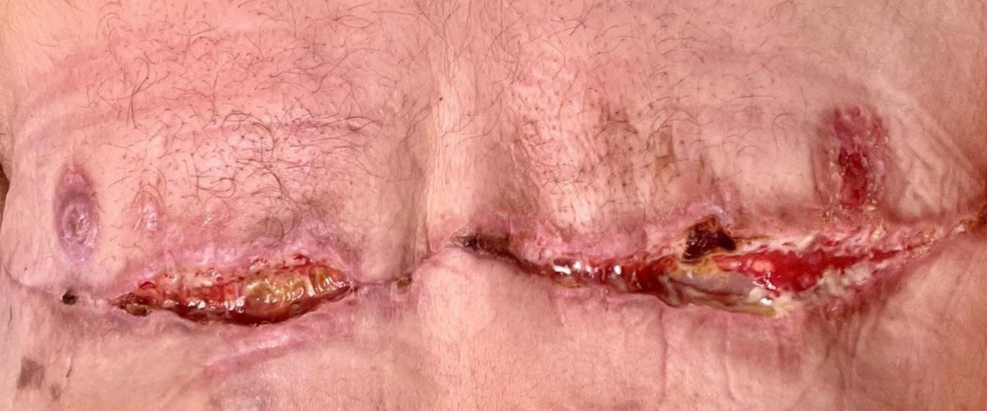 Is top surgery hard to recover from?