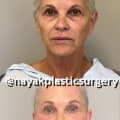 What's the hardest plastic surgery?