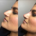What is the least painful cosmetic surgery?