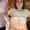 How common are botched tummy tucks?