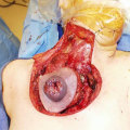What does plastic stand for in plastic surgery?