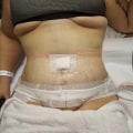Can tummy tuck muscle repair come undone?