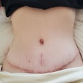 Are tummy tuck complications common?