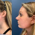 Do you feel different after plastic surgery?