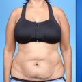How can i slim down after a tummy tuck?