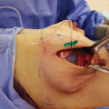 What do they use in plastic surgery?